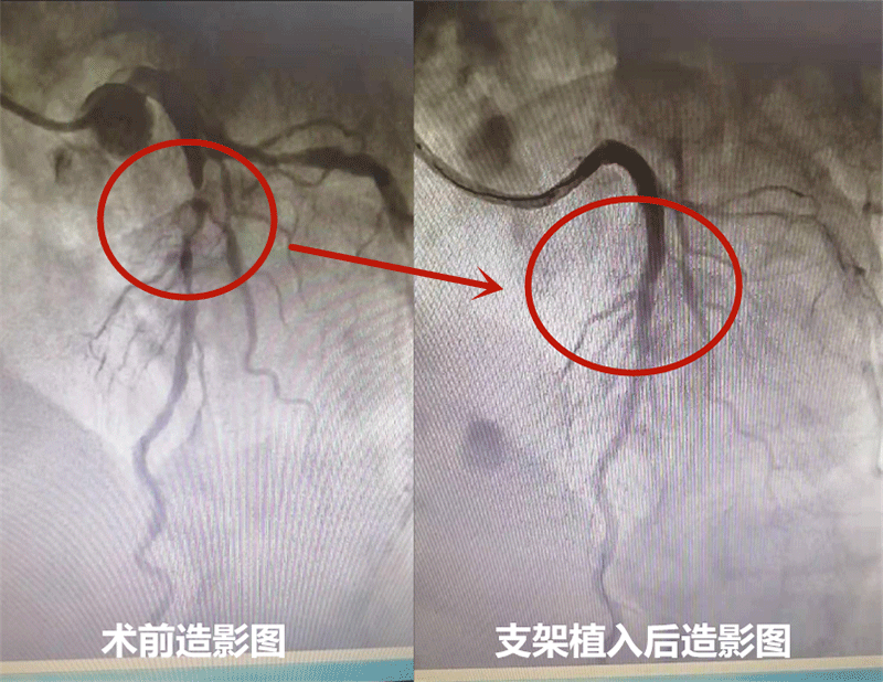 三根冠状动脉血管严重狭窄  乐城心内科完成一台复杂冠脉支架植入术