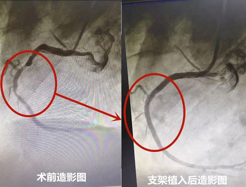 三根冠状动脉血管严重狭窄  乐城心内科完成一台复杂冠脉支架植入术